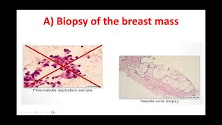 Breast cancer Staging workup part 12 Basics of Breast cancer course [upl. by Hsiri]