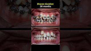 Braces for crowded teeth braces orthodontist dentistry dentist [upl. by Euqinue480]