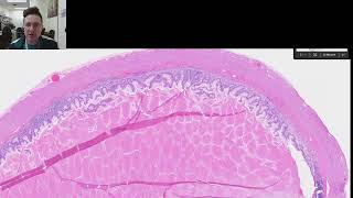 Appendiceal Mucocele vs Lowgrade appendiceal mucinous neoplasm LAMN [upl. by Eelegna]