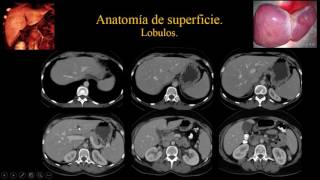 Anatomía Hepática Quirúrgica Aplicada e Imágenes Clase 2 [upl. by Yerdua725]