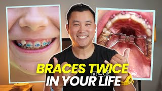 Do You Actually Need Early Braces Early Interceptive Orthodontic Phase I Treatment Explained [upl. by Lennad]