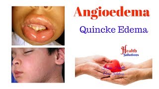 Angioedema  Quincke Edema [upl. by Hsinam799]