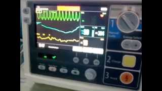 Ventricular Tachycardia in Cardiac Monitor [upl. by Eceinwahs879]