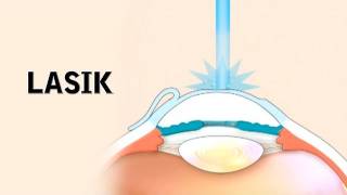 LASIK Surgery and its Risks [upl. by Cris309]