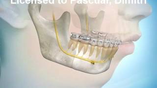 Avancée Mandibulaire avec Genioplastie [upl. by Melise]