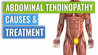 Abdominal Tendinopathy  Causes and Treatment Including Exercises [upl. by Odey]