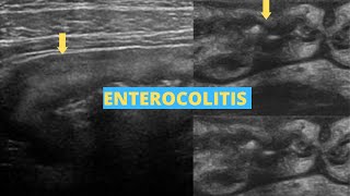 Enterocolitis  Ultrasound Case [upl. by Cassie]