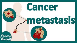 Cancer Metastasis  cancer metastasis mechanism  Metastasis  How do cancers spread in the body [upl. by Teufert]