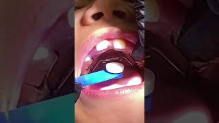 How to Turn Fixed Palatal Expander [upl. by Kendre]