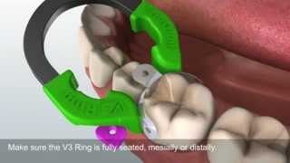 Using the Triodent V3 System [upl. by Hen]