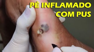 PÉ INFLAMADO E COM PUS  Bicho de Pé Vipé Podologia [upl. by Eiramrebma]