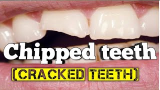 क्या आधे टूटे दांत ठीक हो सकते हैं  chipped teeth  cracked teeth treatment [upl. by Molli]