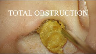 TOTAL OBSTRUCTION  EAR WAX REMOVAL  4KHD [upl. by Trueman437]