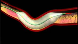 Balloon Angioplasty and Stenting Animation [upl. by Ytsirc]