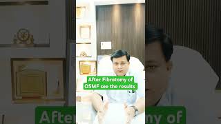 Result after Fibrotomy with Laser excellent response [upl. by Otilrac377]