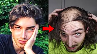 24 Year Old Model Had A Transplant But Stopped Taking Hair Loss Meds And This Is What Happened [upl. by Lirbij]