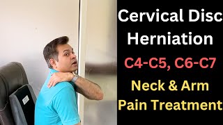 Cervical Disc Herniation C5C6 Neck and Arm Pain Cervical Symptoms Cervical Radiculopathy [upl. by Nitsraek]