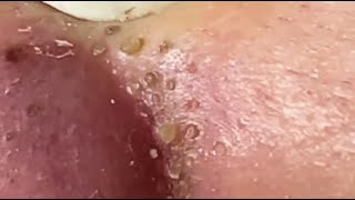 Blackheads extrations Bigblackheads Bigblackheadsonthenose asmr whiteheads face 013 [upl. by Hynda]