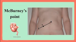 McBurneys point To Diagnose APPENDICITIS [upl. by Fromma]