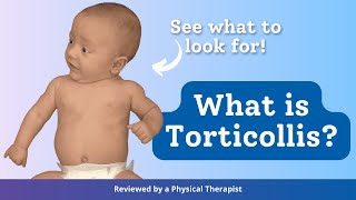 What is Torticollis [upl. by Chae]