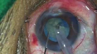 Phacoemulsification in a Mature Cataract Dr Sharath R Yajaman [upl. by Yme]