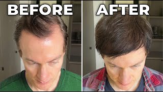 How I Reversed My Hair Loss  Greying [upl. by Jezabelle620]