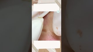 Big Cystic Acne Blackheads Extraction Blackheads amp Milia Whiteheads Removal Pimple Popping shorts [upl. by Mcconaghy]