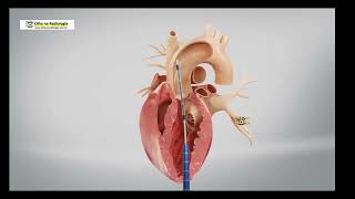 TAVI TRANSAPICAL hemodinâmica hemodinâmica coração [upl. by Eyot652]