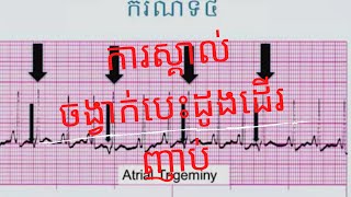 Tachyarrhythmia  ការស្គាល់ចង្វាក់បេះដូងដើរញាប់ [upl. by Ynoyrb40]