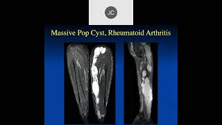 MRI of Inflammatory Lesions of the Knee  Part 1 2023 [upl. by Loveridge134]