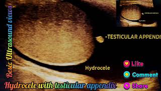 Hydrocele with testicular appendix in ultrasound usg views [upl. by Lindblad246]