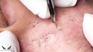 Blackhead Removal  Pimple Popping Treatment  Cystic Acne Spa  Satisfy Facial Elderly Acne  077 [upl. by Adnof]