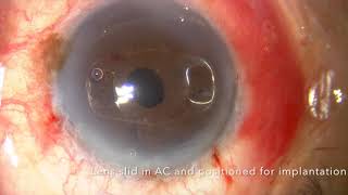 RetroPupillary Iris Claw Artisan Lens Implantation Technique [upl. by Brie]