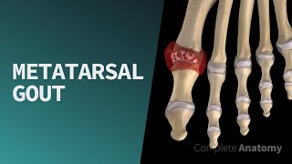 Metatarsal Gout  by Complete Anatomy [upl. by Eecyak18]