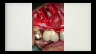 Actinomycosis of the Jaw Nasseh Case report amp Interview with Dr Eleni Gagari [upl. by Ical]