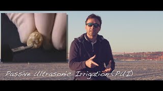 Passive or Active Ultrasonic Activation of Irrigation [upl. by Alper]