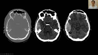 Hematoma Epidural tudo o que você precisa saber na imagem [upl. by Hollister]