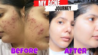 My acne journey that changes my life  How i cleared my skin in 4 months [upl. by Nylednarb459]