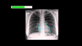 Chest XRay Reading Method  ABCDE UndergroundMed [upl. by Devinna]