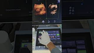 Renal Bosniak II Cortical Cyst on Multiplaner 3D Ultrasound [upl. by Kenta]