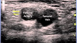 Femoral Nerve Sonoanatomy  QMH AED Ultrasound Casebook 2013 Video 12 [upl. by Faden676]