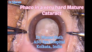 Phaco in a mature hard cataract very long standing [upl. by Adlar]