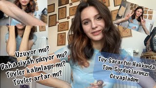 Tüm Sorularınıza Cevap VerdimSesu Tüy Sarartıcı✨Kalınlaşmauzamaartmakoyulaşma🧐Ne kadar kalıcı [upl. by Idyak]