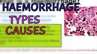 Pathology Lectures Haemorrhage Types and Causes Hemorrhage  EXPLAINED IN 4 MINUTES [upl. by Eak]