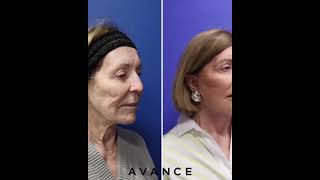 Mini Facelift Neck Lift amp CO2 Laser Resurfacing  Avance Plastic Surgery Institute Dr Erez Dayan [upl. by Nylisoj]