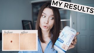 HOW TO REMOVE SKIN TAGS AT HOME FAST  Does Claritag Work My Honest Review [upl. by Bordy]