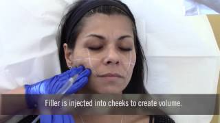 Injecting fillers in cheeks at Advanced Dermatology [upl. by Eimia]