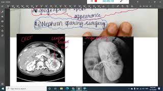 classification of renal tumors  Pathology [upl. by Htinek]