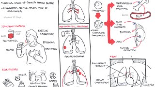 Lung Cancer  Overview [upl. by Papp]