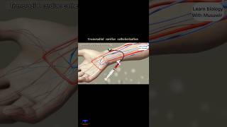 Transradial Cardiac Catheterization  animation shortvideo [upl. by Namaan]